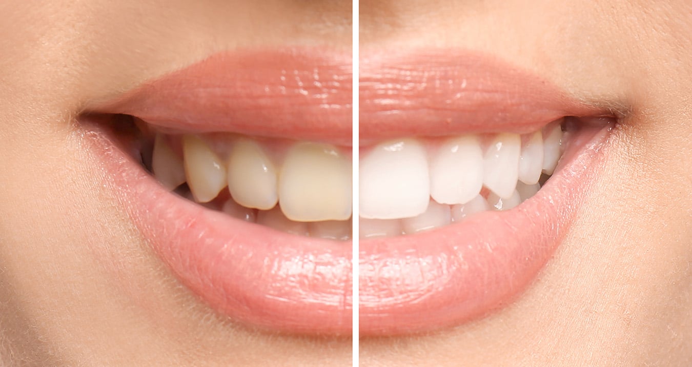 teeth whitening Brentwood Dental Center in Brentwood, TN