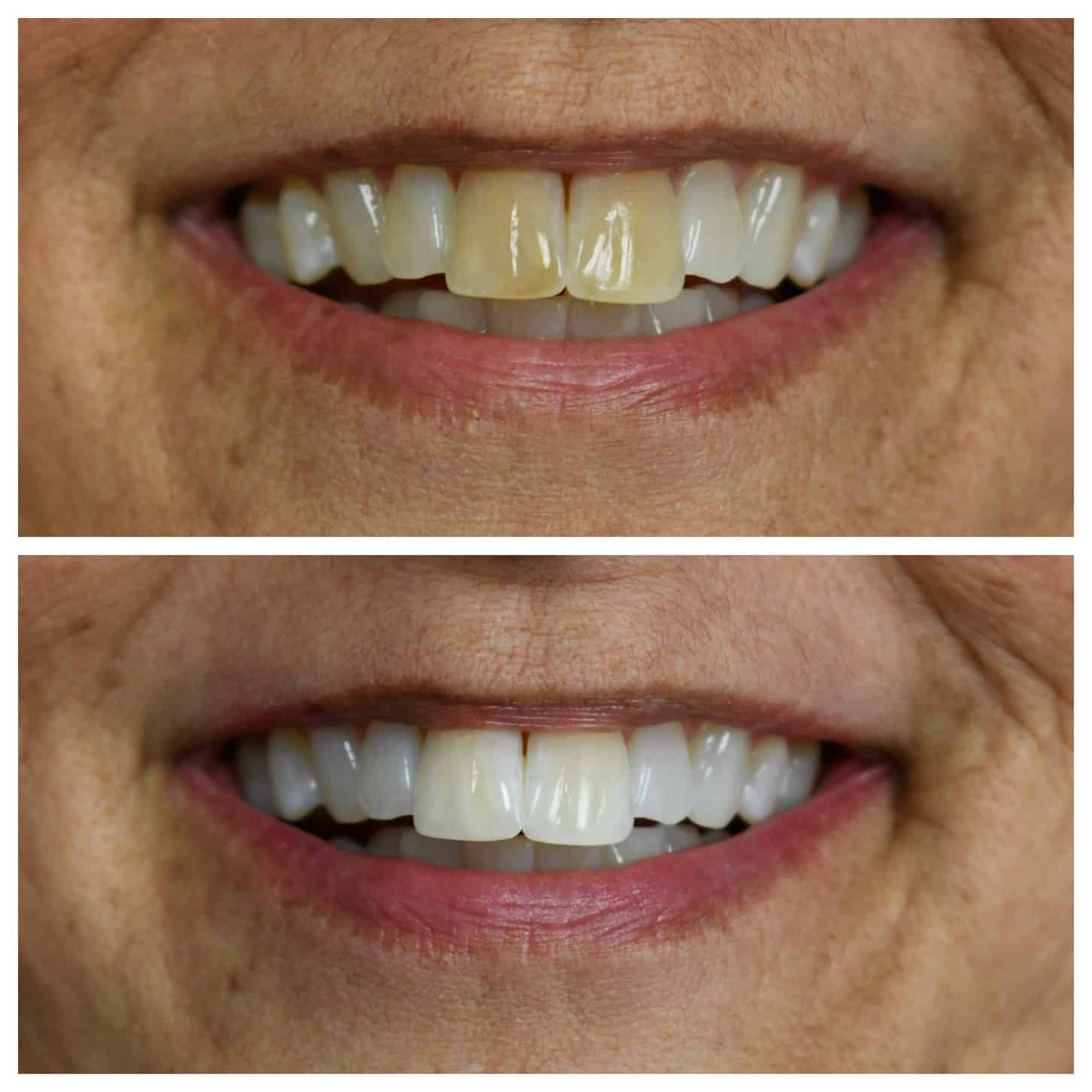 KOR teeth whitening treatment available in Brentwood, TN