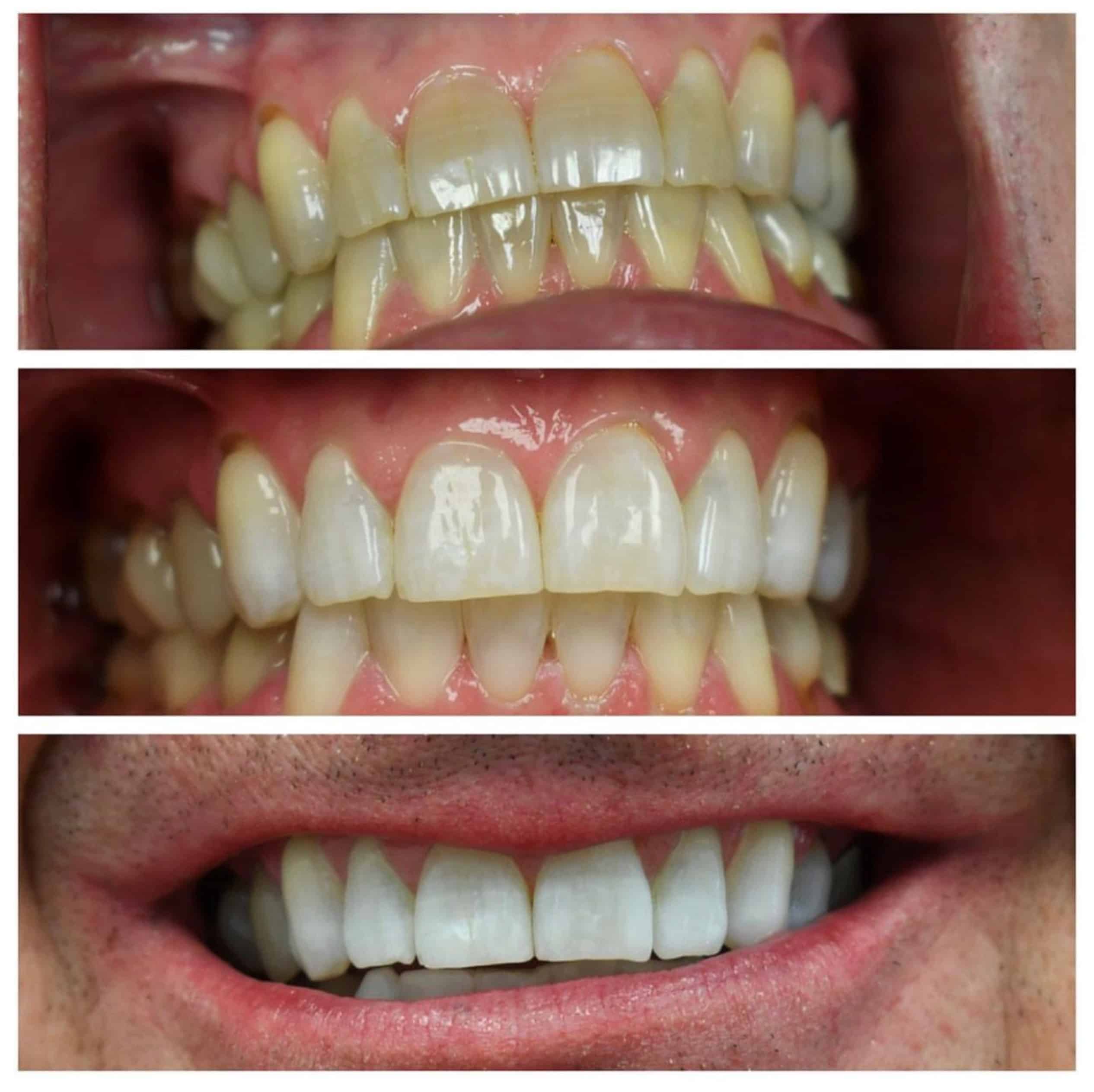 Man after getting a tooth whitening treatment in Brentwood, TN