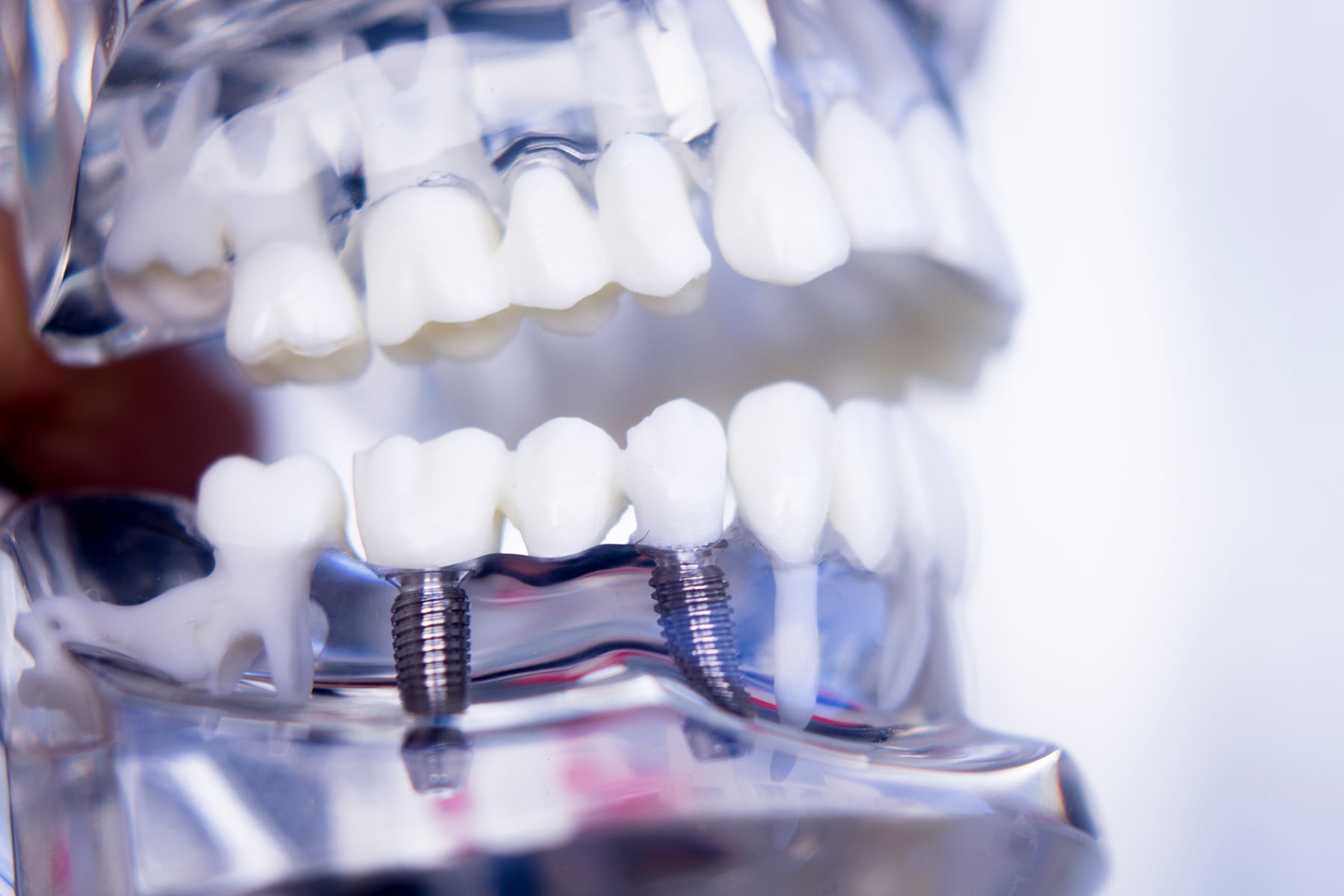 All-on-4 dental implants available in Brentwood, TN