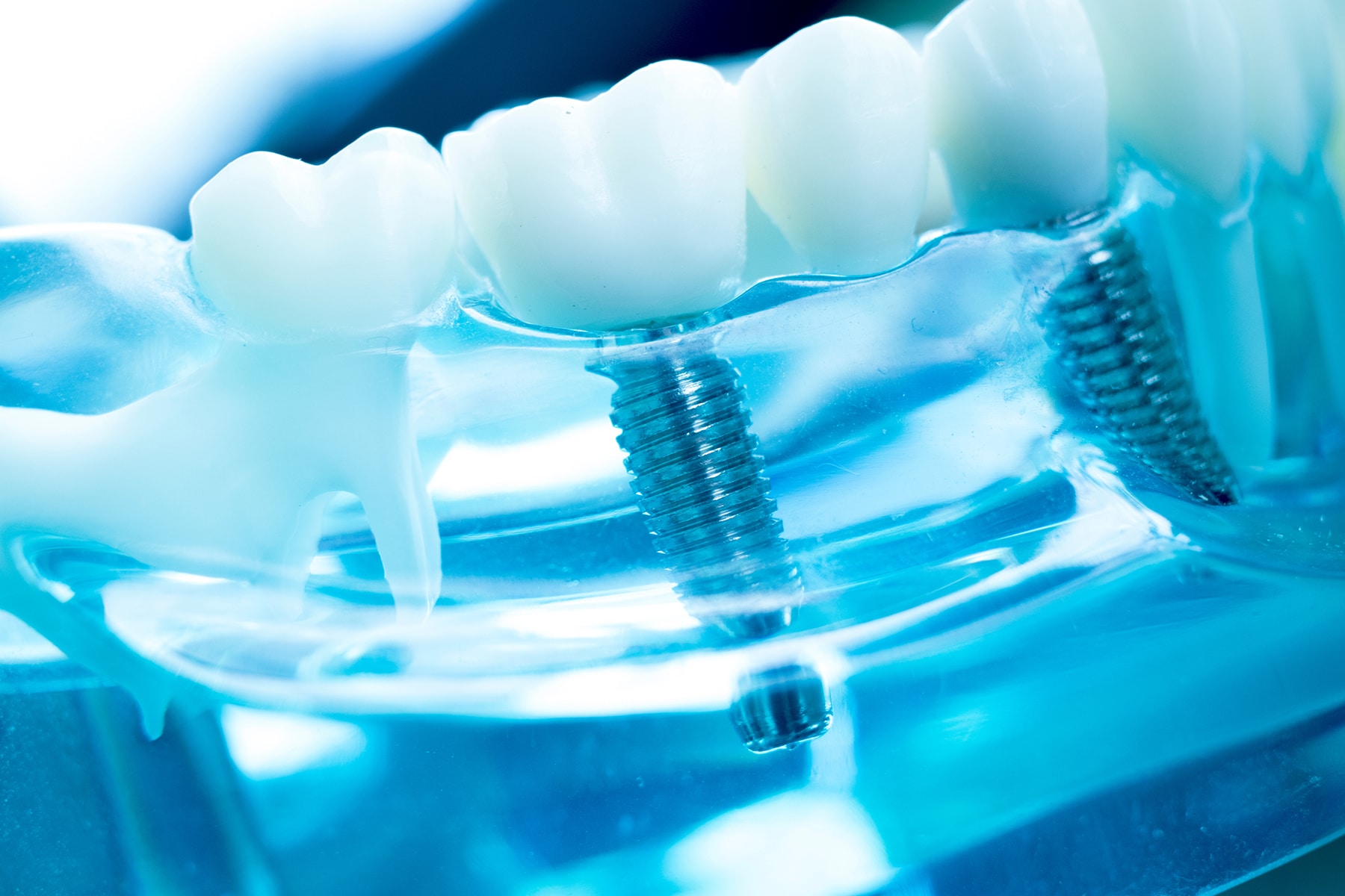 Dental implant restorations available in Brentwood, TN