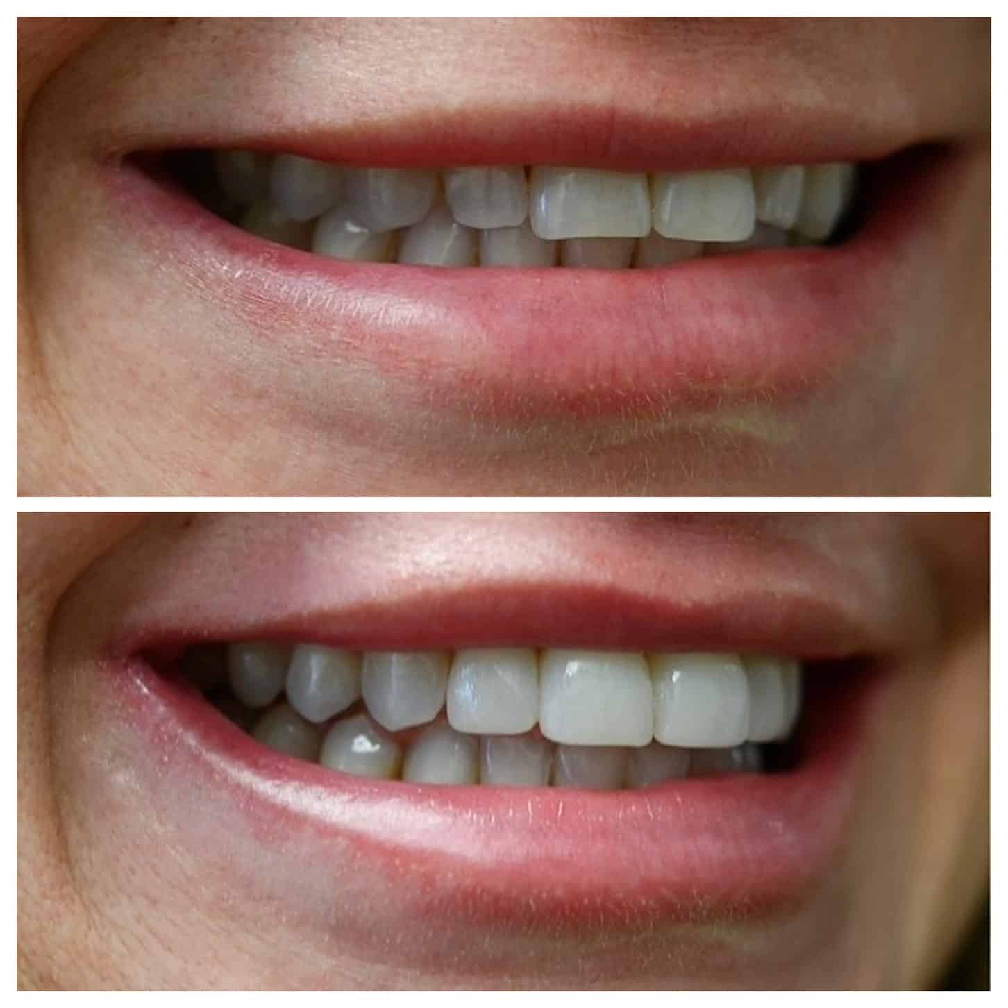 KOR teeth whitening treatment available in Brentwood, TN