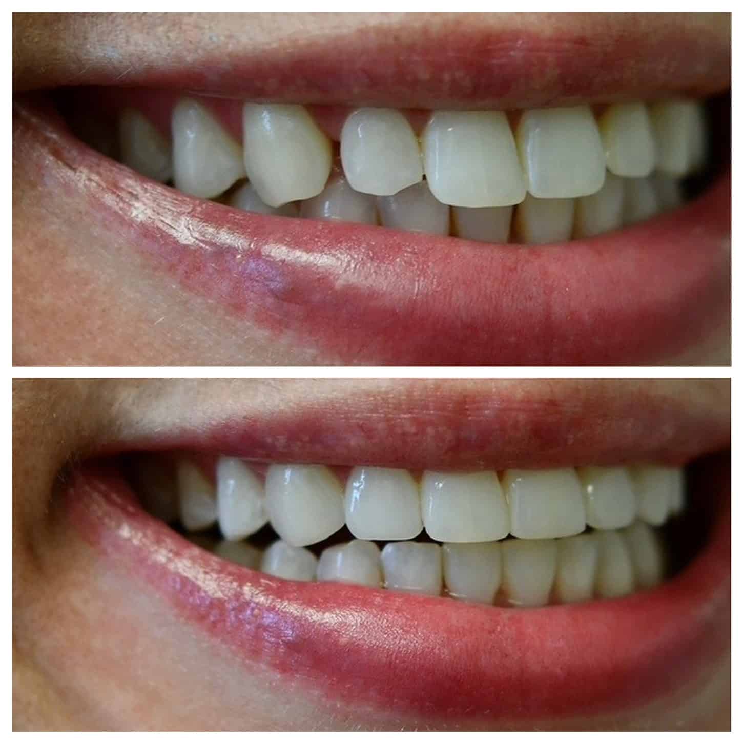 Professional dental whitening service options in Brentwood, TN