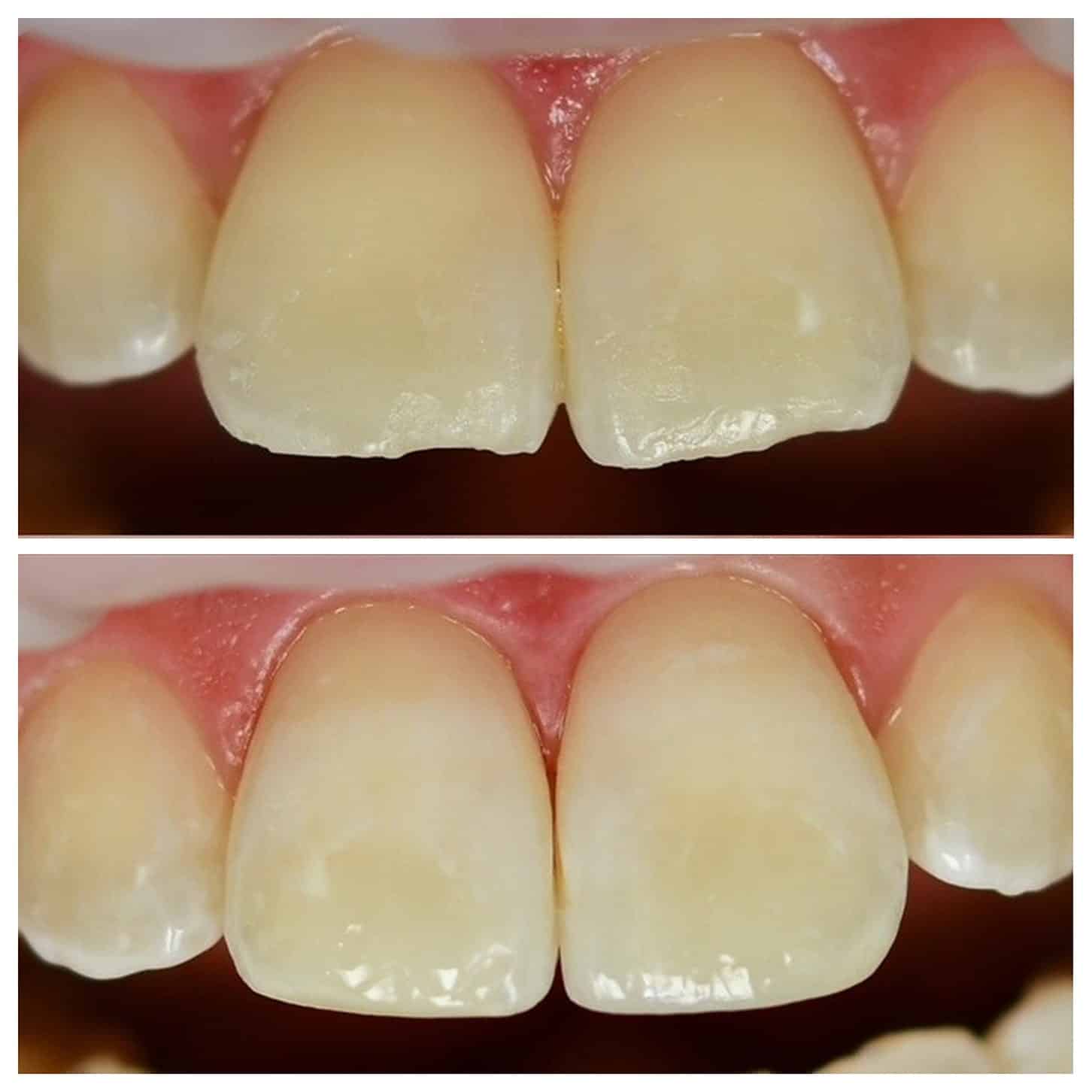 Man smiling at a cosmetic dental bonding appointment in Brentwood, TN