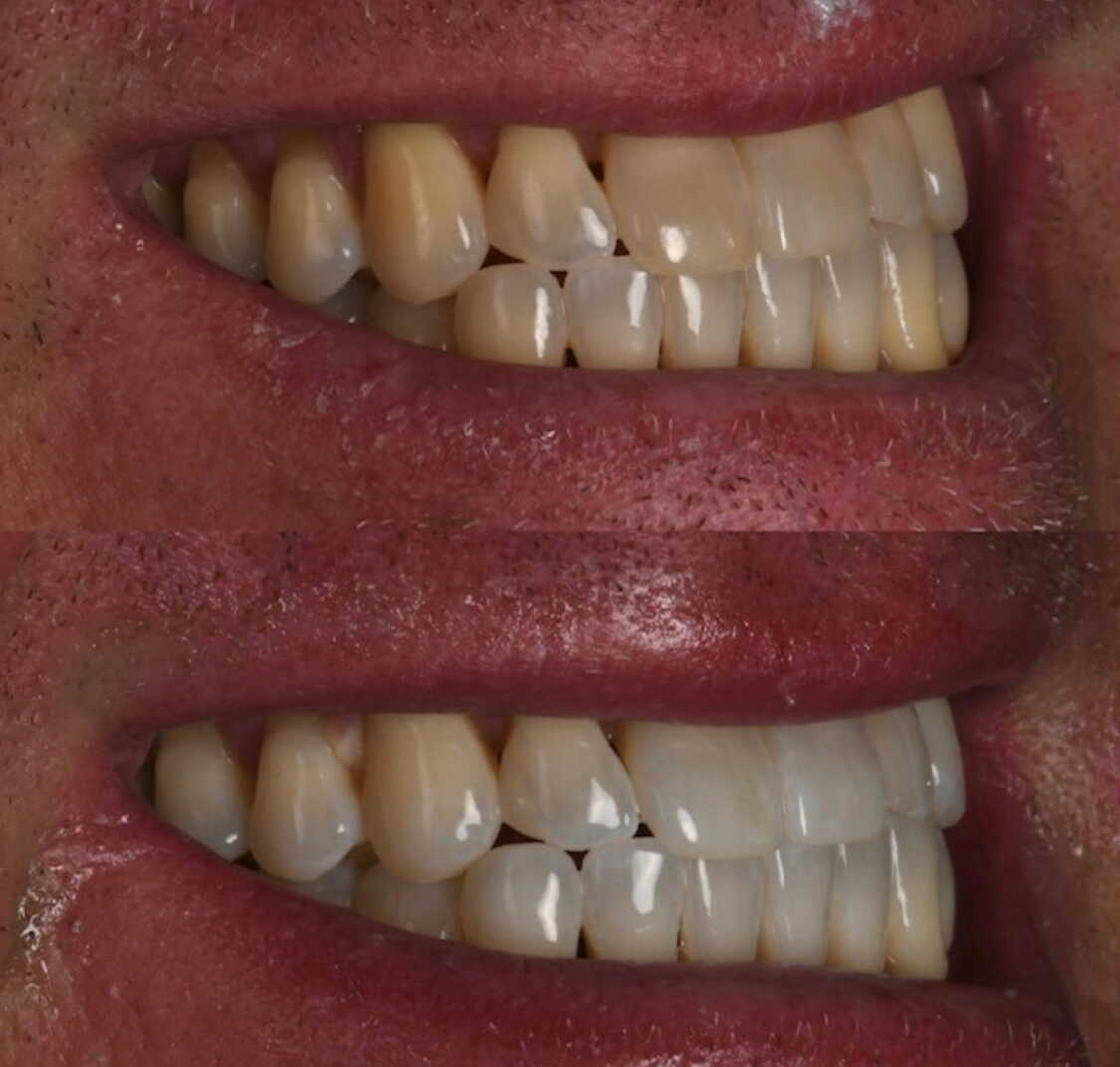 professional teeth whitening results from Brentwood Dental Center in Brentwood TN